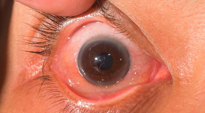 Doctor en Casa: todo lo que debes saber sobre las cataratas en los ojos