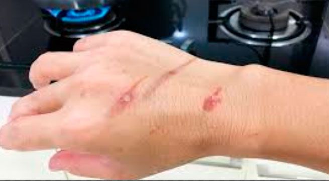 Quemaduras caseras y qué hacer en caso de emergencia [VIDEO]