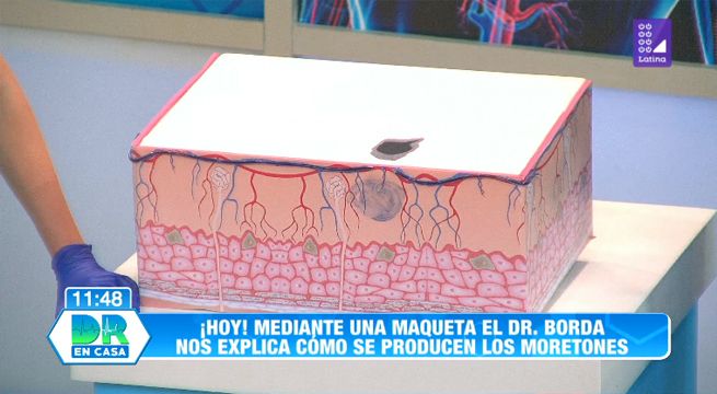 Doctor en Casa: Conoce todo sobre los moretones