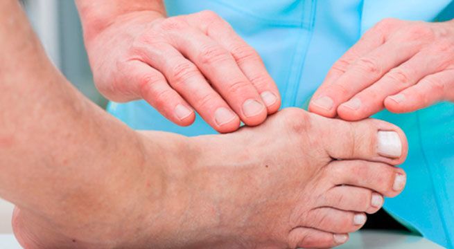 Doctor en Casa: conoce todo sobre los juanetes [VIDEO]