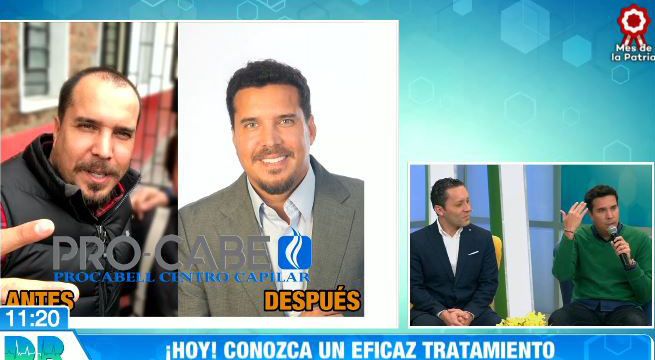 Dr. en Casa: Conoce todo sobre el tratamiento de implante capilar