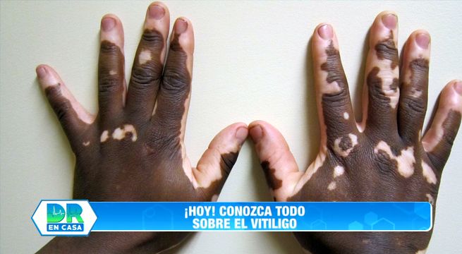 Doctor en Casa: Aprenda todo sobre el vitíligo