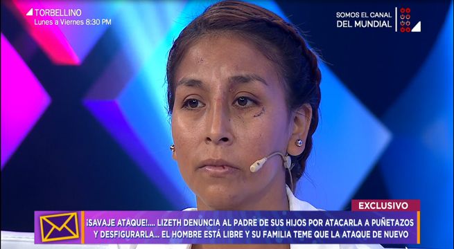 Tengo algo que decirte: Mujer acusa al padre de sus hijos de atacarla y desfigurarla