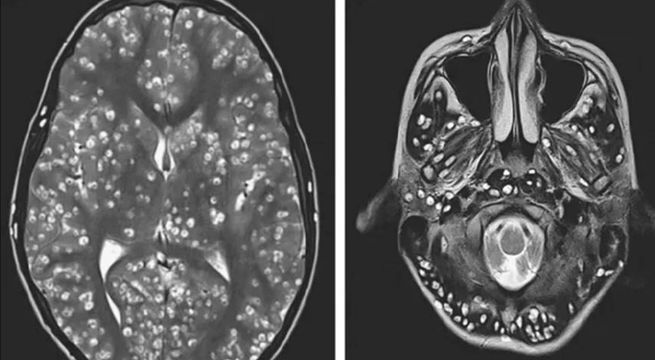 Joven come carne de cerdo y se convierte en víctima mortal de larvas parasitarias