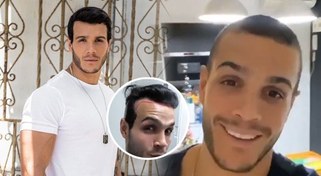Mario Irivarren se trasplantó cabello y sorprende a todos con los resultados [VIDEO]
