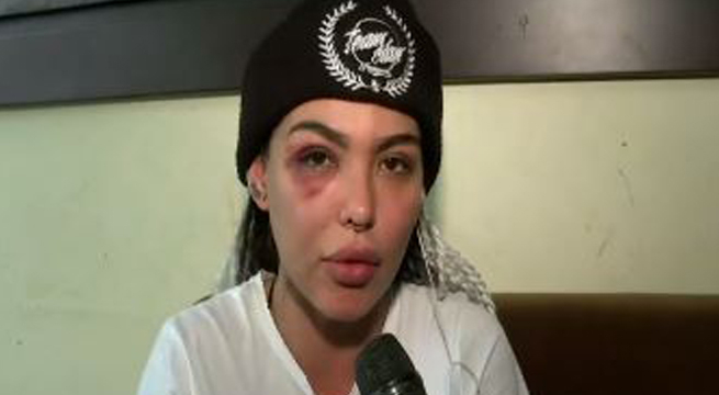 Angie Jibaja denuncia haber sido agredida y desfigurada por dueño de conocido restobar