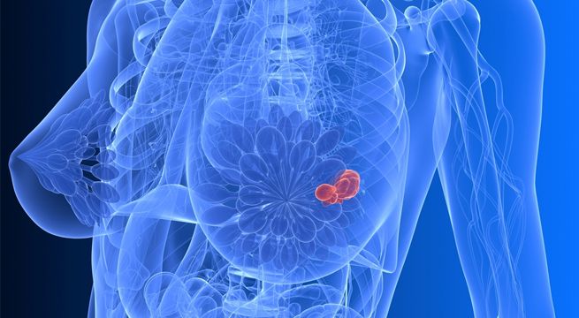 Detección temprana del cáncer de mama: ¿la mamografía es mejor que el autoexamen de mama?