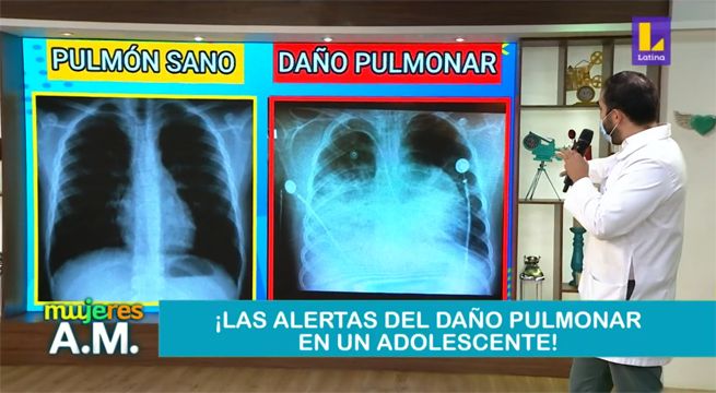 Atención: ¿Cómo reconocer los daños pulmonares en un adolescente?