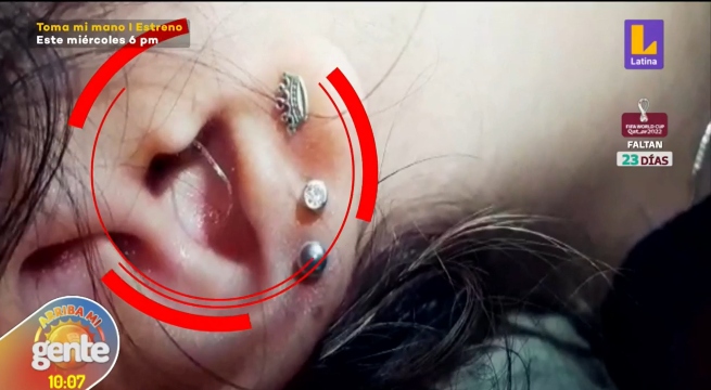 Adolescente vive con un cable salido de su oído tras una mala colocación de un implante auditivo