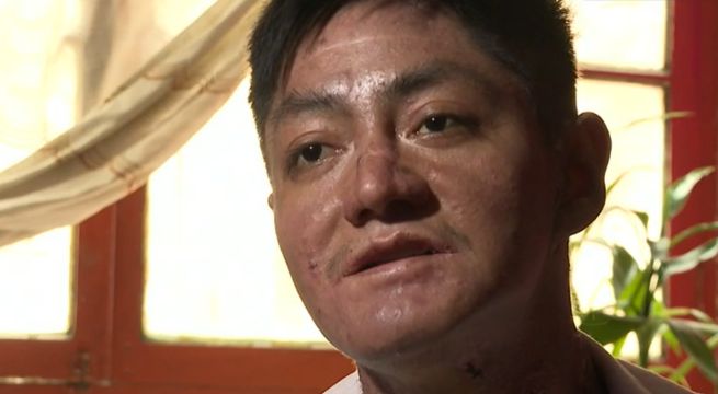 La dolorosa enfermedad de la piel mariposa: los  casos en Perú que requieren de tu ayuda