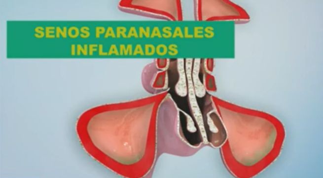 ¿Son lo mismo? Arriba mi Gente detalla las diferencias entre rinitis, sinusitis y cómo combatirlas