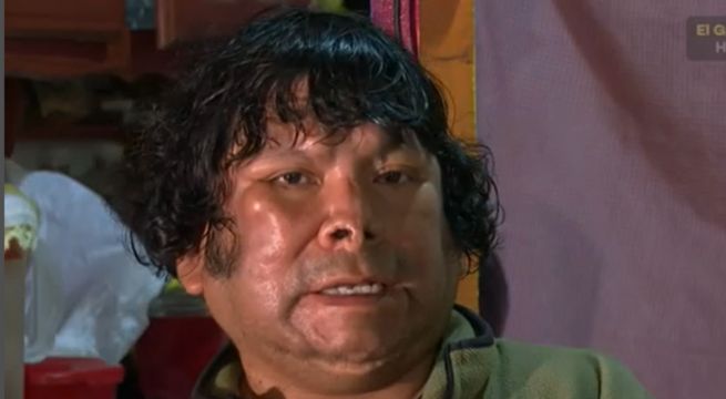 Hombre que sufre de extraña enfermedad reclama que le quitaron bono de salud