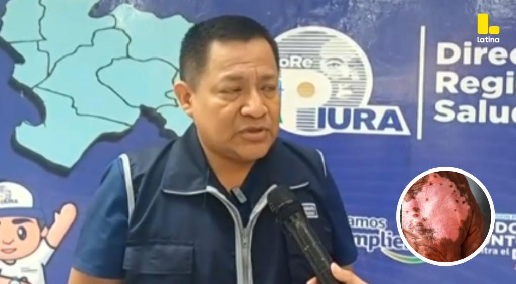 Lepra en Perú 2025: ¿Cuál es el estado de SALUD del PRIMER CASO en Piura?